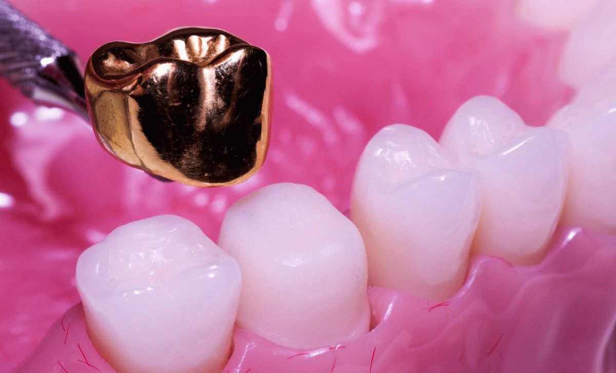 Стоматологическая клиника, статья: Коронки на зуб: виды, какие лучше 
