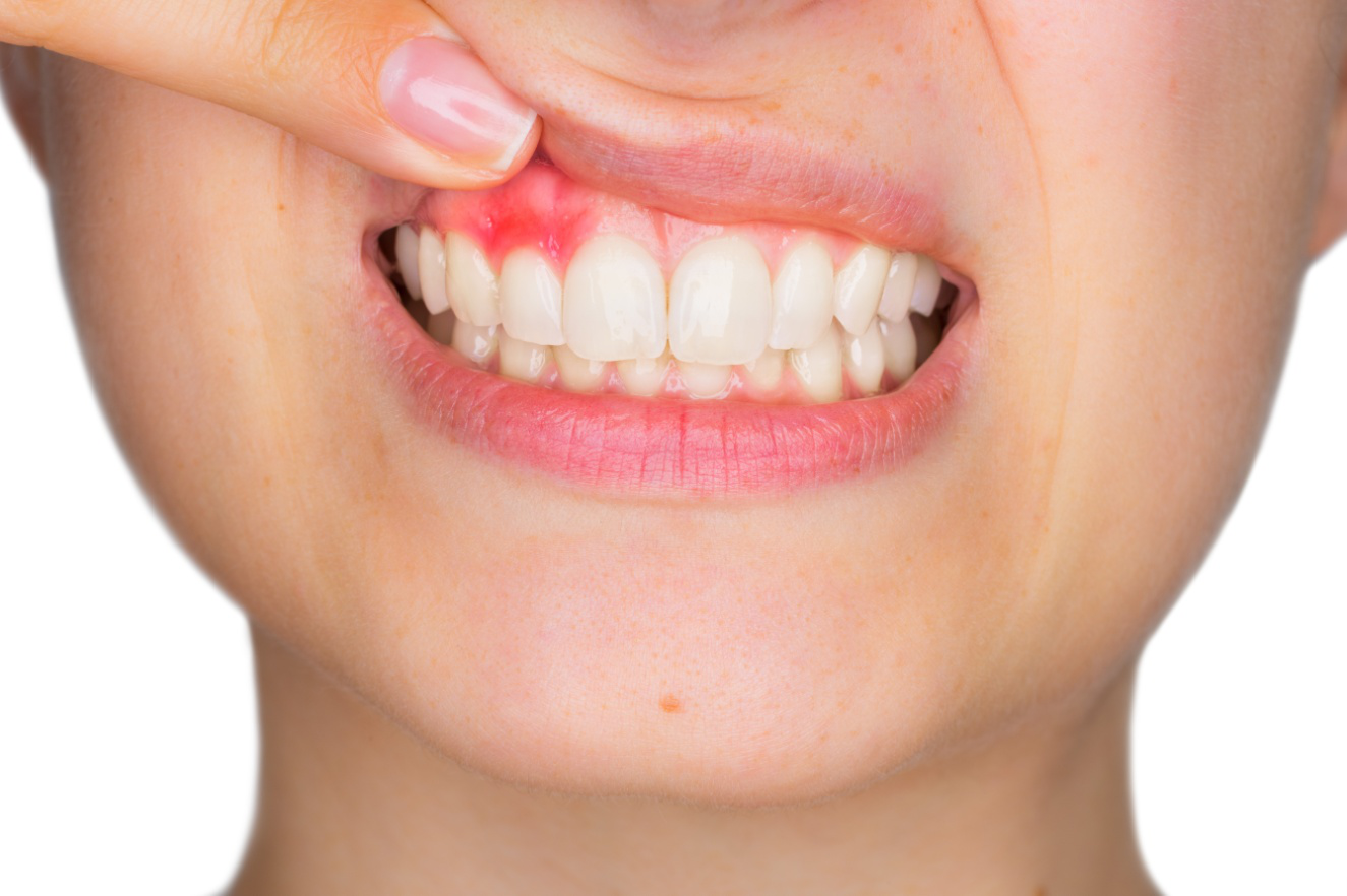 Стоматологическая клиника, статья: Сколько дней заживает десна после удаления зуба 