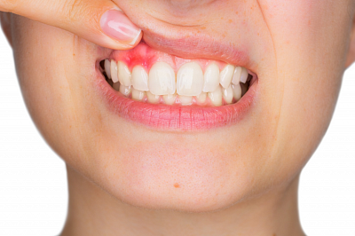 Сколько дней заживает десна после удаления зуба